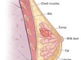 What are breast cancer symptoms